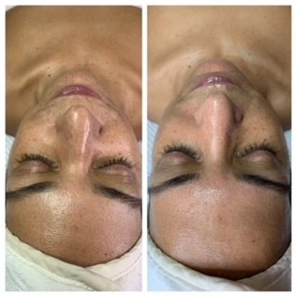 Oxygen Facial