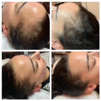 microneedling of the hairline for new hairgrowth