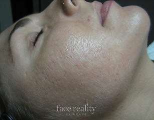 facial acne after 6 treatments