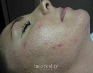 facial acne before
