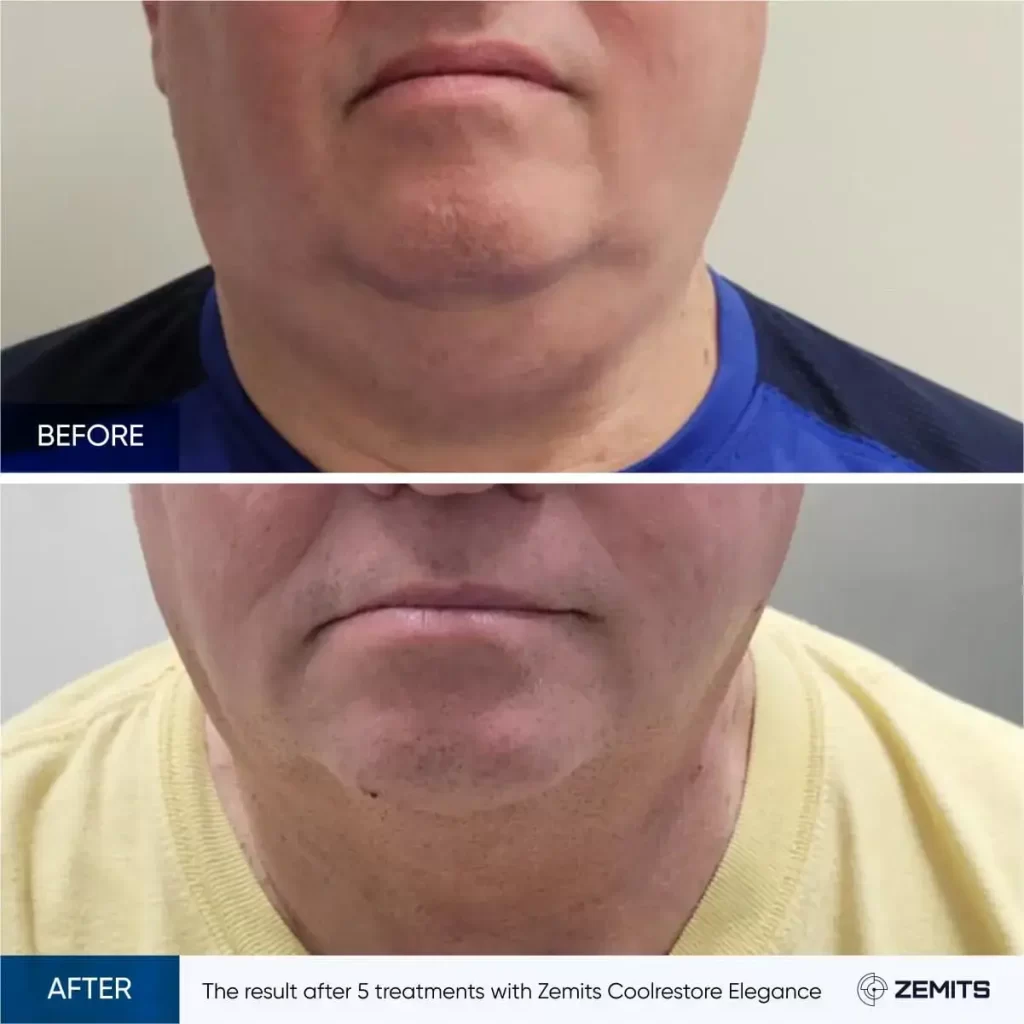 The result after 5 treatments with Zemits Coolrestore Elegance